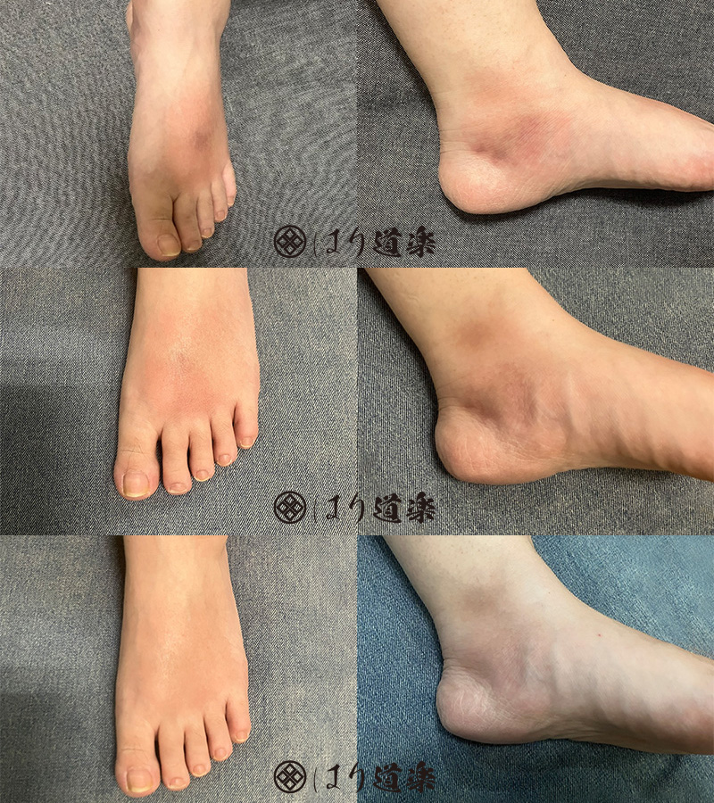 上から順に、初回施術直後、2回目（初回の翌日）の施術後、3回目（初回から5日後）の施術後の状態。