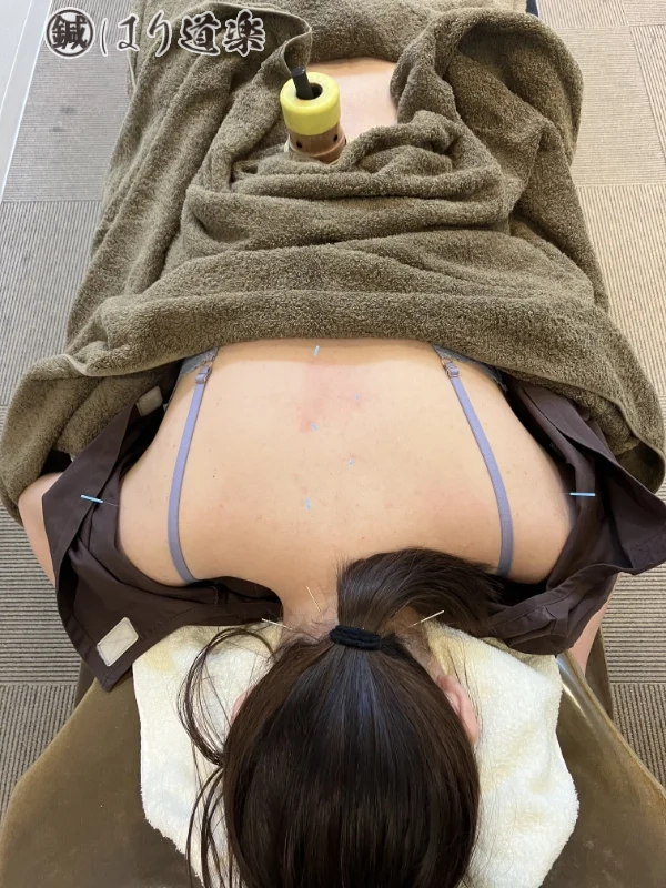 X年11月27日（8回目）施術時。後頭下筋群、背中の胸椎沿いと肩甲骨部に鍼、腰椎部に棒温灸をしているところを頭側から撮影。