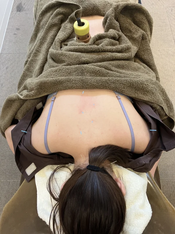 X年11月27日（8回目）施術時。後頭下筋群、背中の胸椎沿いと肩甲骨部に鍼、腰椎部に棒温灸をしているところを頭側から撮影。